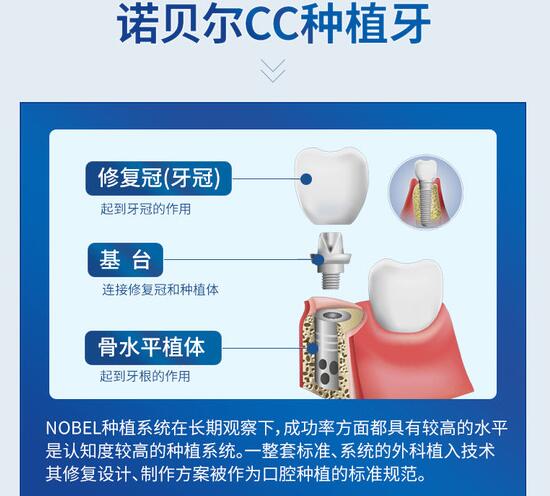 诺贝尔牙齿种植价格及详细步骤指南