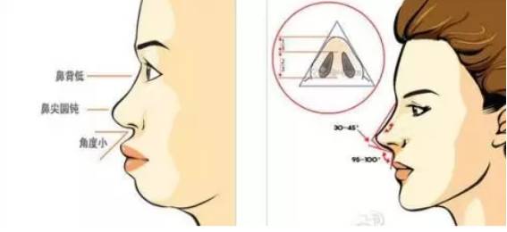 最新隆鼻材料，小巷中的美学宝藏探索